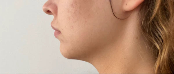Before treatment