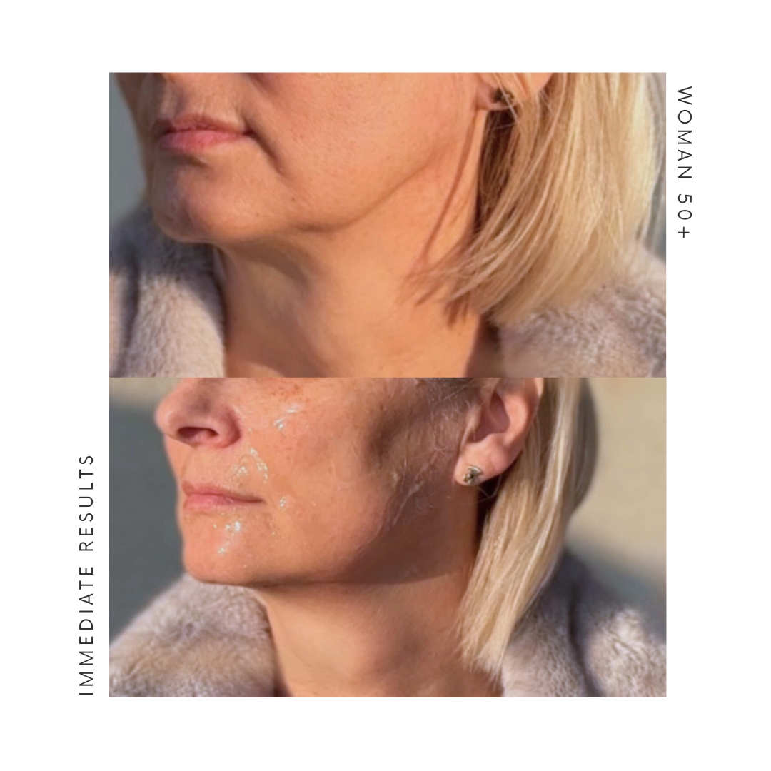 AURA RF lifting massager, collagen booster with RF and LED